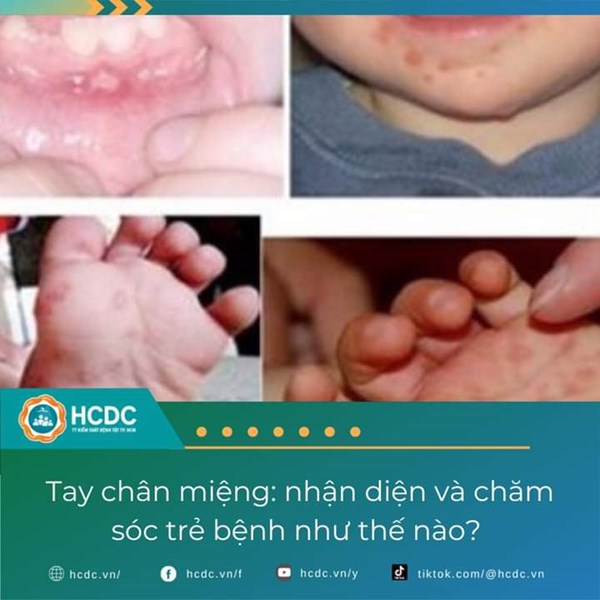 Tay chân miệng: nhận diện và chăm sóc trẻ bệnh như thế nào?