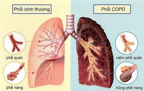 Truyền thông hưởng ứng ngày bệnh phổi tắc nghẽn mạn tính 
( ngày 16/11/2022)
